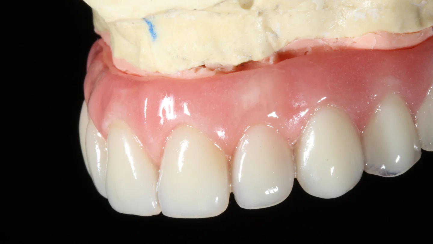 implantes dentários Porto Alegre