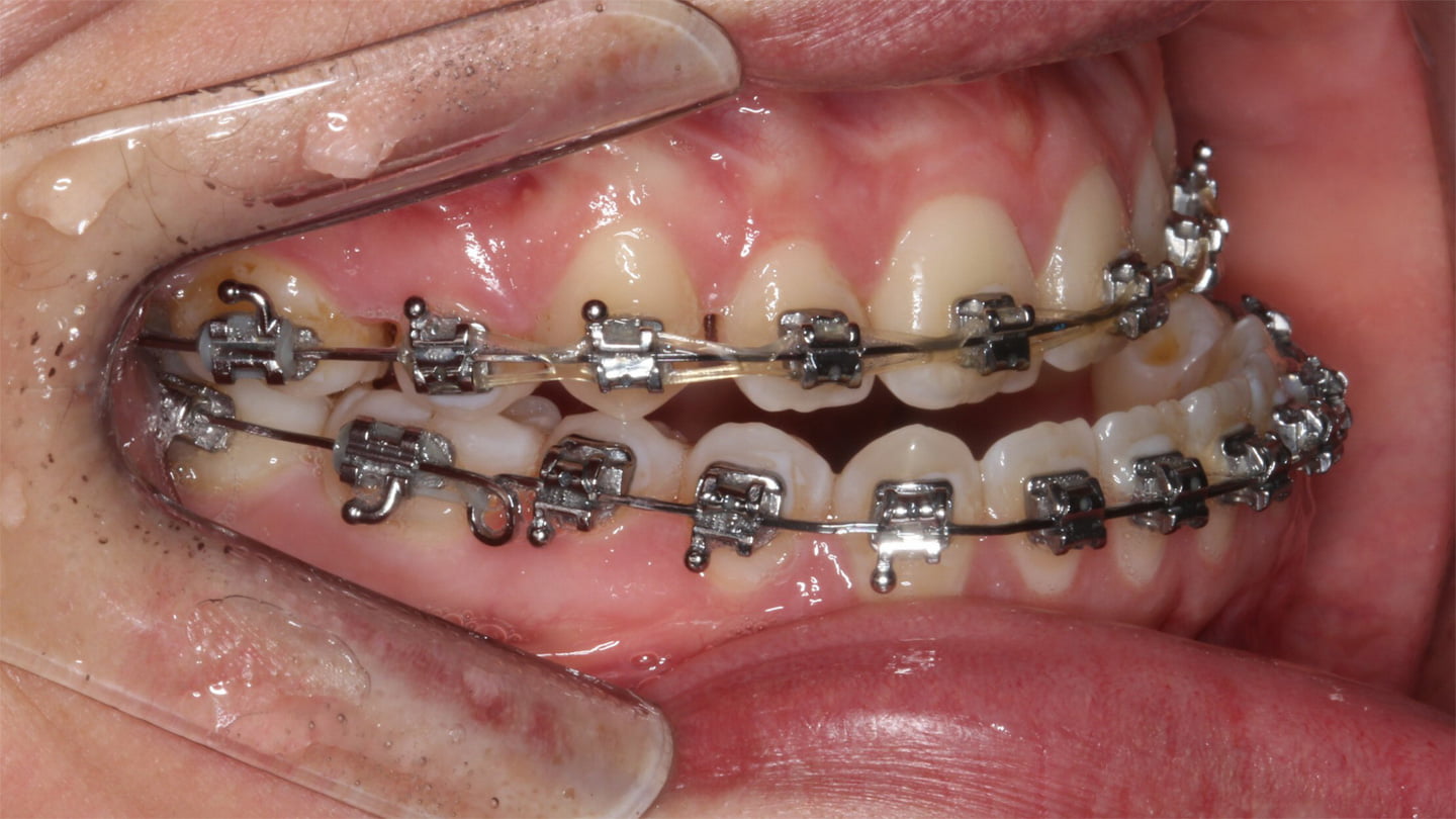 Cirurgia Ortognática Porto Alegre