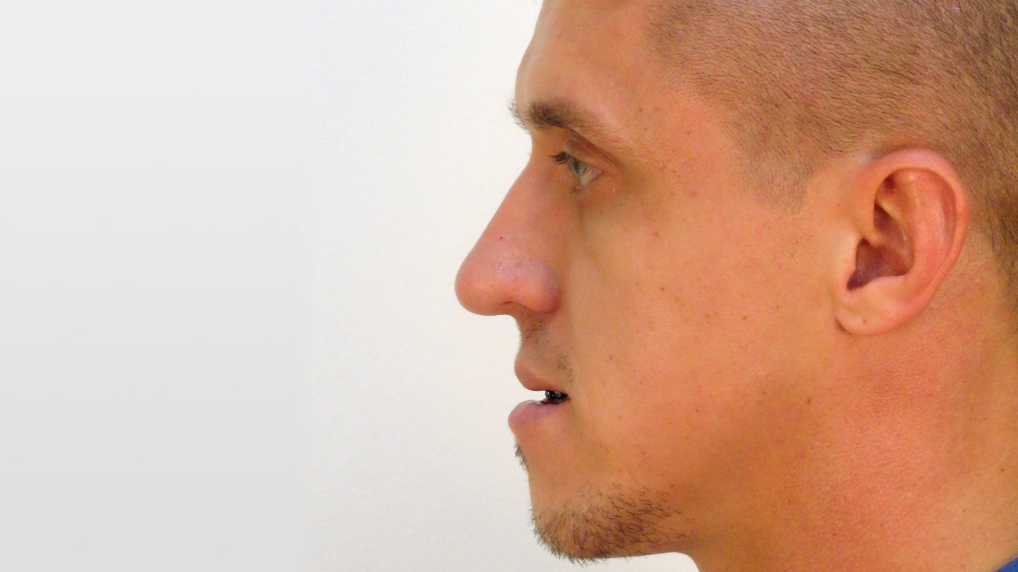 Cirurgia Ortognática Porto Alegre