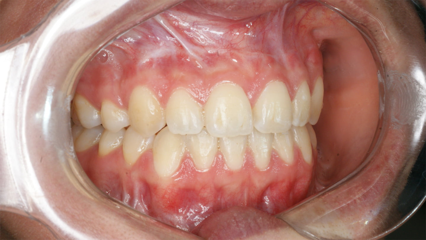 Cirurgia Ortognática Porto Alegre