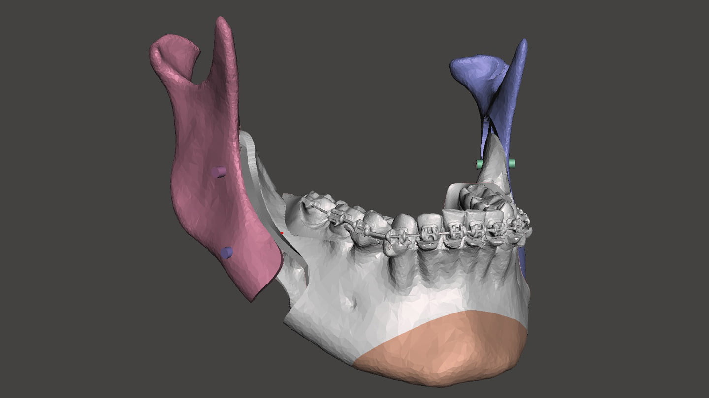 Cirurgia Ortognática Porto Alegre