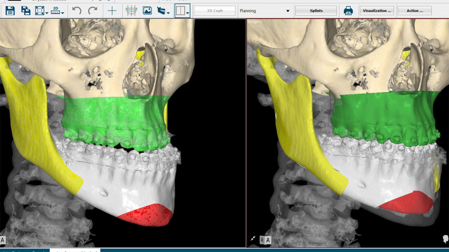 Cirurgia Ortognática Porto Alegre