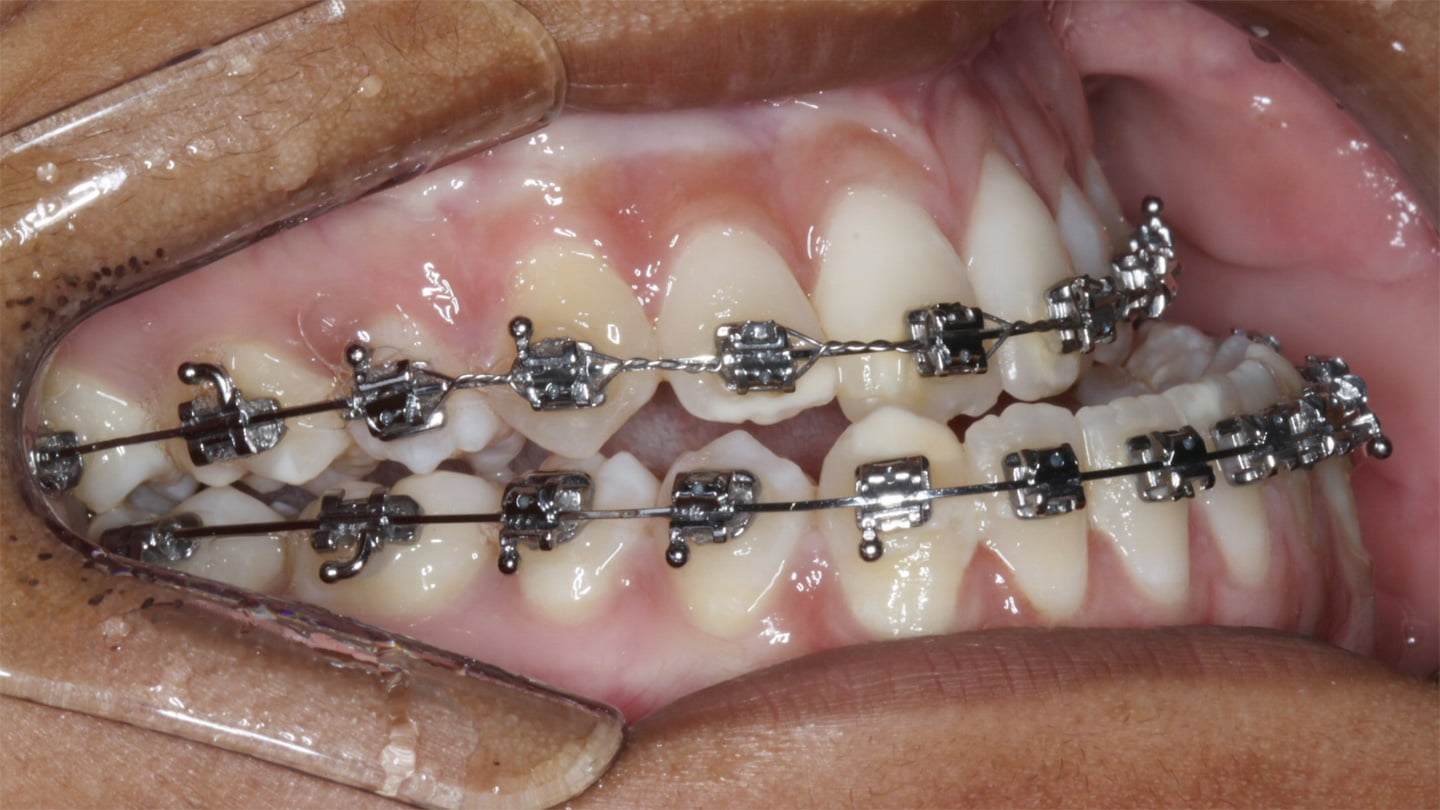 Cirurgia Ortognática Porto Alegre