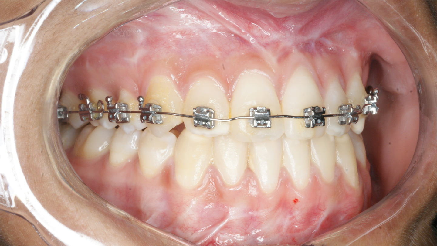 Cirurgia Ortognática Porto Alegre